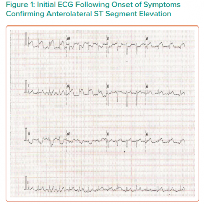 Initial ECG Following Onset of Symptoms Confirming Anterolateral ST Segment Elevation