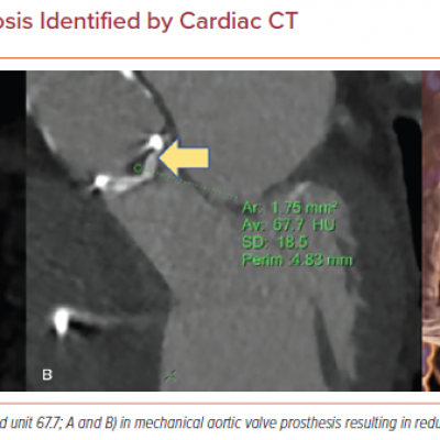 Mechanical Valve Thrombosis Identified by Cardiac CT