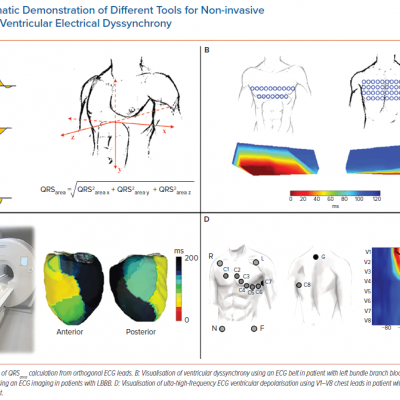 Schematic Demonstration of Different Tools for Non-invasive Assessment of Ventricular Electrical Dyssynchrony