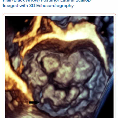 Bileaflet Mitral Valve Prolapse with Flail Black Arrow Posterior Lateral Scallop Imaged with 3D Echocardiography