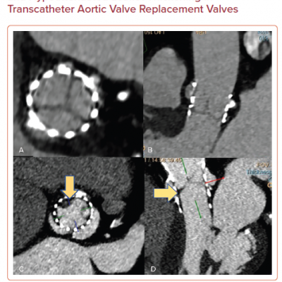 Cardiac CT Images of Normal and Hypoattenuated Leaflet Thickening in Transcatheter Aortic Valve Replacement Valves