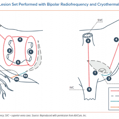 Cox Maze IV Lesion Set Performed with Bipolar Radiofrequency and Cryothermal Ablation