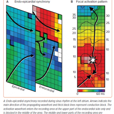 Endo-epicardial Asynchrony and Focal Activation Pattern