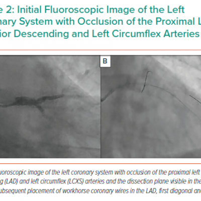 Initial Fluoroscopic Image of the Left Coronary System with Occlusion of the Proximal Left Anterior Descending and Left Circumflex Arteries