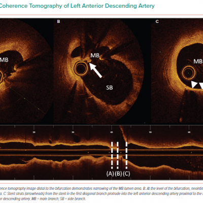 Optical Coherence Tomography of Left Anterior Descending Artery