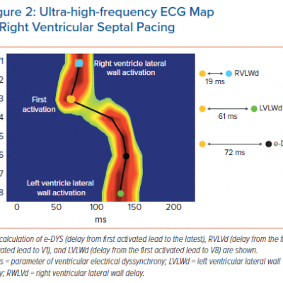 Ultra-high-frequency ECG Map in Right Ventricular Septal Pacing
