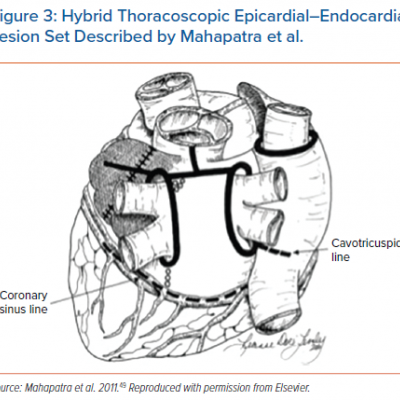Hybrid Thoracoscopic Epicardial–Endocardial Lesion Set Described by Mahapatra et al.