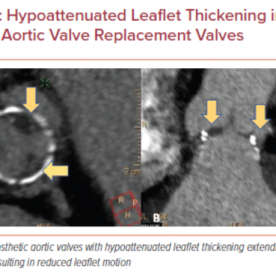 Hypoattenuated Leaflet Thickening in Surgical Aortic Valve Replacement Valves