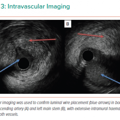 Intravascular Imaging