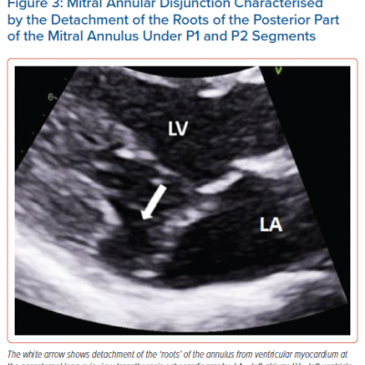 Mitral Annular Disjunction Characterised by the Detachment of the Roots of the Posterior Part of the Mitral Annulus Under P1 and P2 Segments
