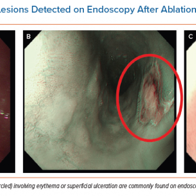 Oesophageal Mucosal Lesions Detected on Endoscopy After Ablation