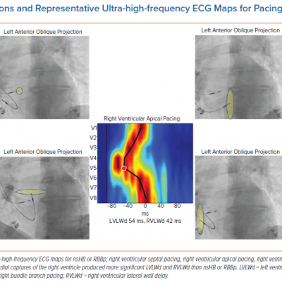 Pacing Locations and Representative Ultra-high-frequency ECG Maps for Pacing Sites