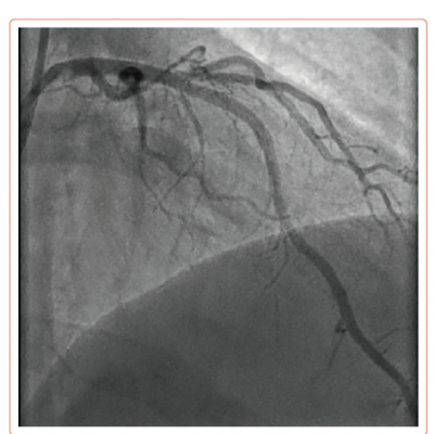 Post-interventional Angiography
