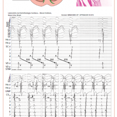 Accessory Atrioventricular Node Atriofascicular Pathway