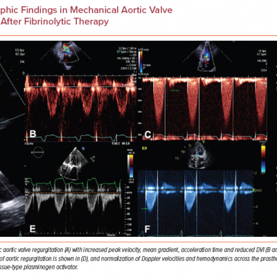 Echocardiographic Findings in Mechanical Aortic Valve Thrombosis Before and After Fibrinolytic Therapy