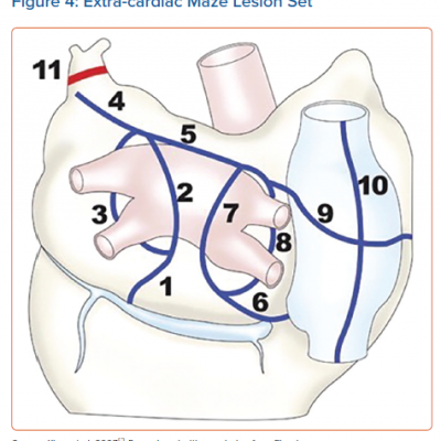 Extra-cardiac Maze Lesion Set