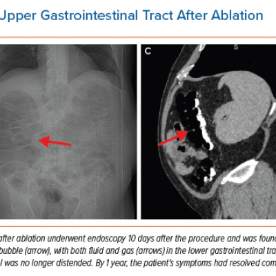 Motility Disorders of the Upper Gastrointestinal Tract After Ablation
