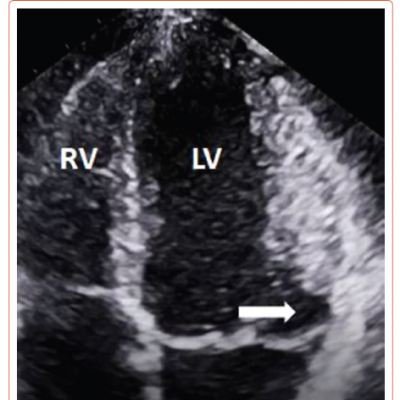 Presence of Mitral Annular Disjunction at the Four-chamber View on Transthoracic Echocardiography