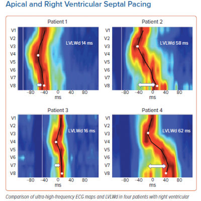 Ultra-high-frequency ECG Maps and Left Ventricular Lateral Wall Delay with Right Ventricular Apical and Right Ventricular Septal Pacing