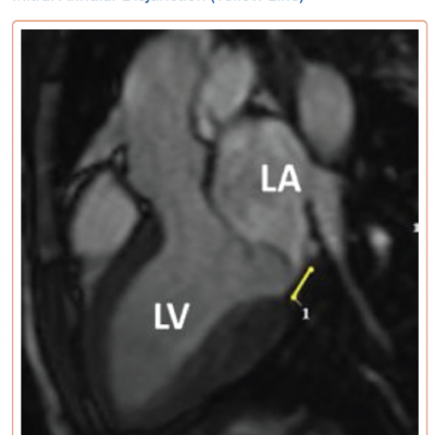 Cardiac MRI with Evidence of Mitral Annular Disjunction Yellow Line