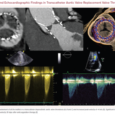 CT and Echocardiographic Findings in Transcatheter Aortic Valve Replacement Valve Thrombosis