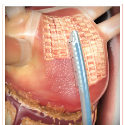 Posterior Wall Ablation in the Contemporary Hybrid Convergent Procedure