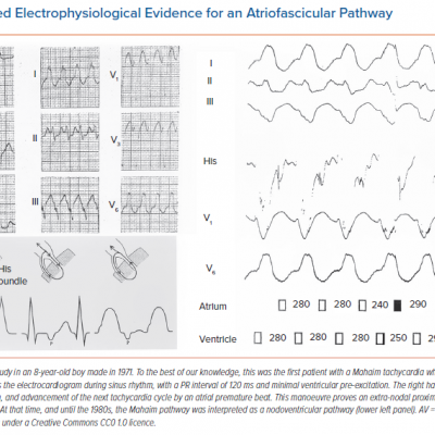 Unrecognised Electrophysiological Evidence for an Atriofascicular Pathway