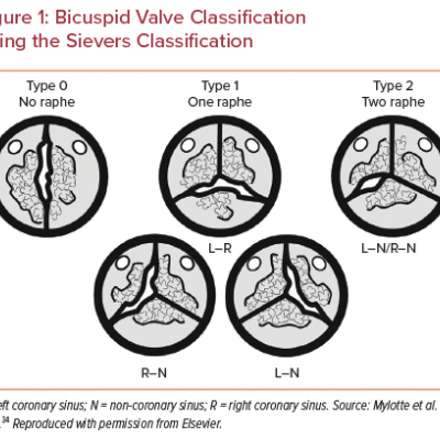Bicuspid Valve Classification Using the Sievers Classification