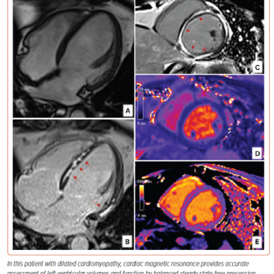 Cardiac Magnetic Resonance in Dilated Cardiomyopathy