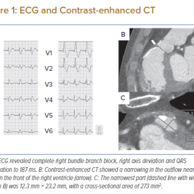 ECG and Contrast-enhanced CT
