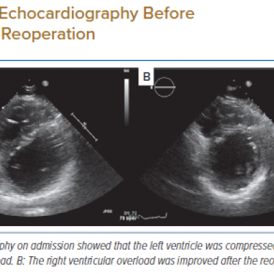 Echocardiography Before and After Reoperation