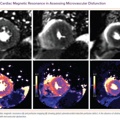 Role of Cardiac Magnetic Resonance in Assessing Microvascular Disfunction
