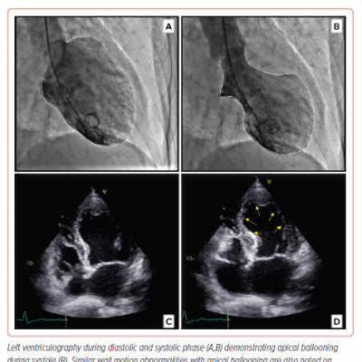 Imaging in Takotsubo Cardiomyopathy