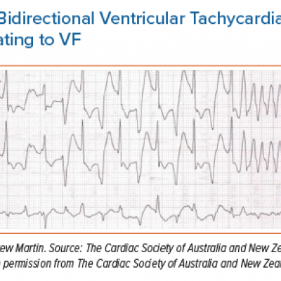 Bidirectional Ventricular Tachycardia Degenerating to VF