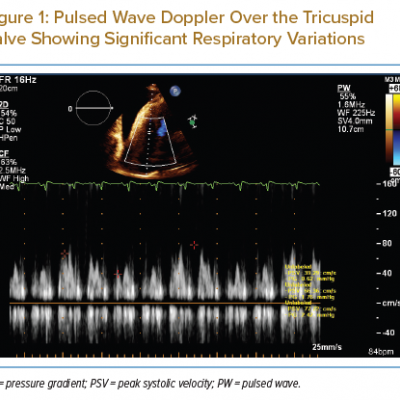 Pulsed Wave Doppler Over the Tricuspid Valve Showing Significant Respiratory Variations