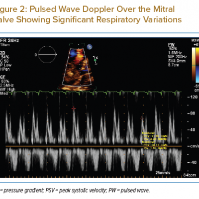 Pulsed Wave Doppler Over the Mitral Valve Showing Significant Respiratory Variations