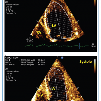 Apical Four-chamber View Showing Mild Left Ventricular Systolic Dysfunction by the Modified Simpson’s Method