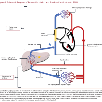 Schematic Diagram of Fontan Circulation and Possible Contributors to FALD