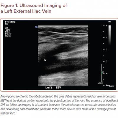 Ultrasound Imaging of a Left External Iliac Vein