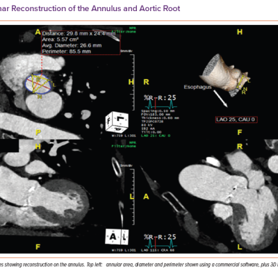 Multiplanar Reconstruction of the Annulus and Aortic Root