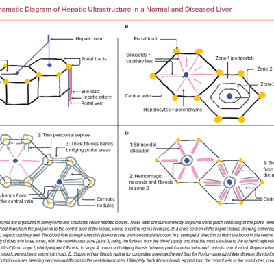 Schematic Diagram of Hepatic Ultrastructure in a Normal and Diseased Liver