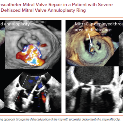 Edge-to-edge Transcatheter Mitral Valve Repair in a Patient with Severe Mitral Regurgitation Due to Dehisced Mitral Valve Annuloplasty Ring
