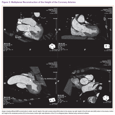 Multiplanar Reconstruction of the Height of the Coronary Arteries