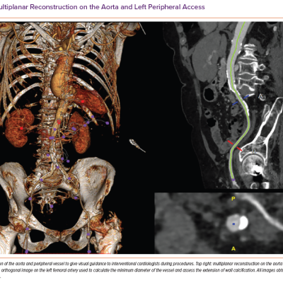 Multiplanar Reconstruction on the Aorta and Left Peripheral Access