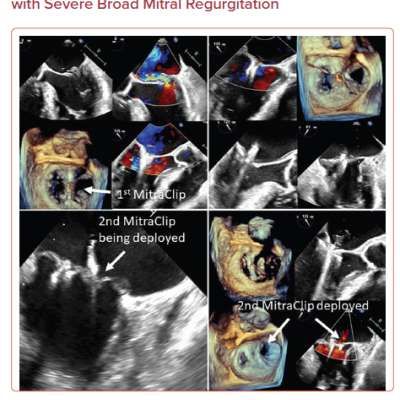 Two MitraClip Approach for a Patient with Severe Broad Mitral Regurgitation