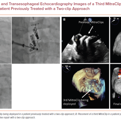 Fluoroscopic and Transesophageal Echocardiography Images of a Third MitraClip Being Deployed in a Patient Previously Treated with a Two-clip Approach