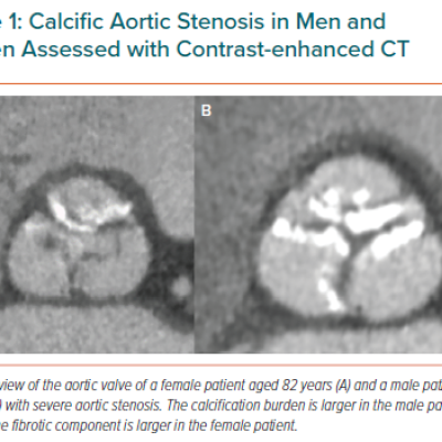 Calcific Aortic Stenosis in Men and Women Assessed with Contrast-enhanced CT