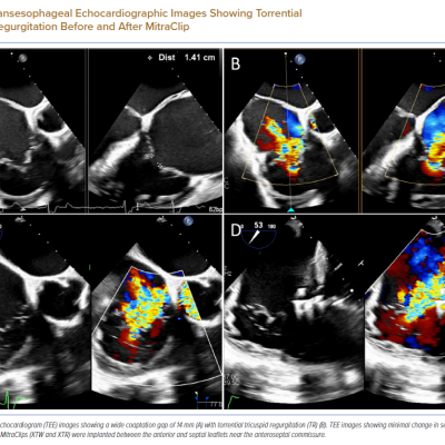 Transesophageal Echocardiographic Images Showing Torrential Tricuspid Regurgitation Before and After MitraClip