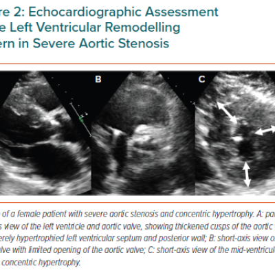 Echocardiographic Assessment of the Left Ventricular Remodelling Pattern in Severe Aortic Stenosis