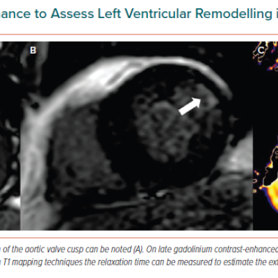 Cardiac Magnetic Resonance to Assess Left Ventricular Remodelling in Severe Aortic Stenosis